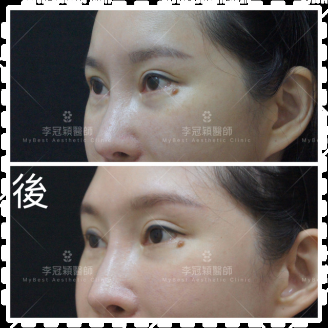 東方臉墊眉骨(隆眉骨)的輪廓效果,顏面T區打造的逆轉! IMG_4409.PNG - 墊煤骨