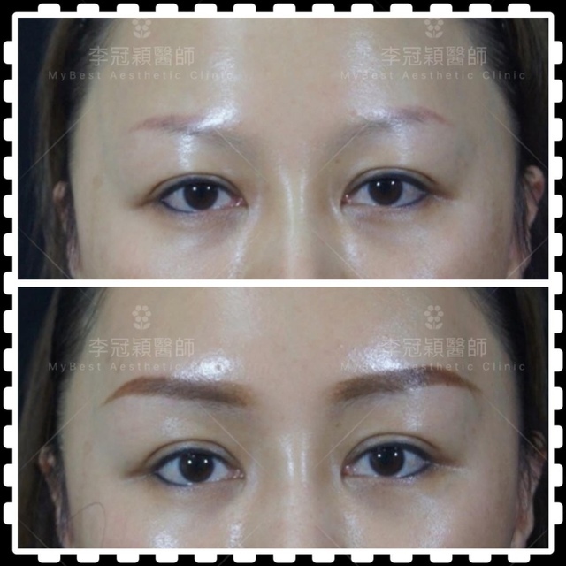 東方臉墊眉骨(隆眉骨)的輪廓效果,顏面T區打造的逆轉! 東方臉墊眉骨(隆眉骨)的輪廓效果,顏面T區打造的逆轉!