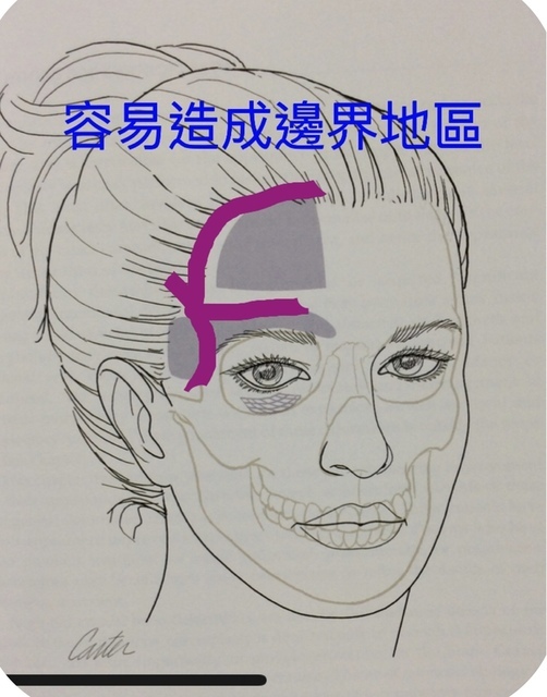 額頭假體整形的穩定性分析