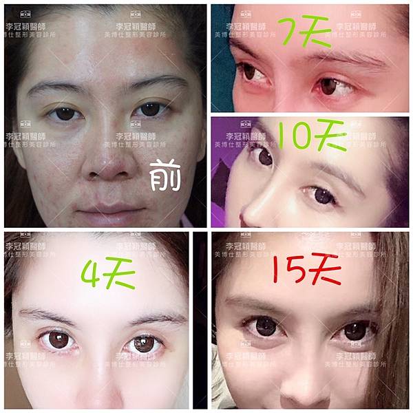 東方臉墊眉骨(隆眉骨)的輪廓效果,顏面T區打造的逆轉! 東方臉墊眉骨(隆眉骨)的輪廓效果,顏面T區打造的逆轉!