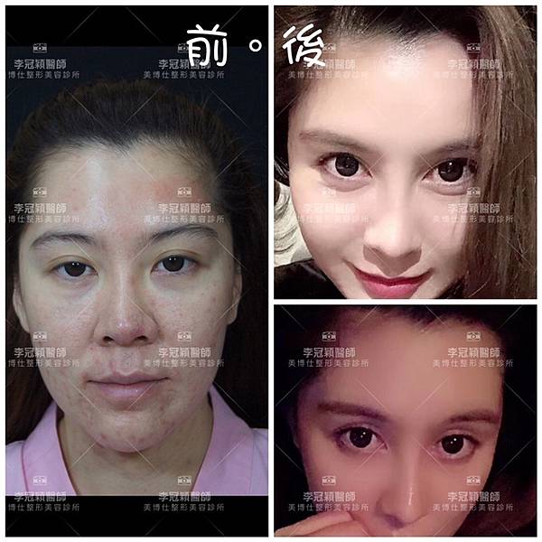 東方臉墊眉骨(隆眉骨)的輪廓效果,顏面T區打造的逆轉! 東方臉墊眉骨(隆眉骨)的輪廓效果,顏面T區打造的逆轉!