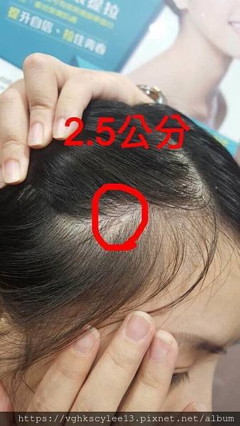 東方臉墊眉骨(隆眉骨)的輪廓效果,顏面T區打造的逆轉! 東方臉墊眉骨(隆眉骨)的輪廓效果,顏面T區打造的逆轉!