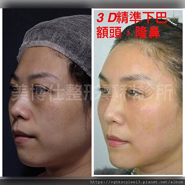 東方臉墊眉骨(隆眉骨)的輪廓效果,顏面T區打造的逆轉! 東方臉墊眉骨(隆眉骨)的輪廓效果,顏面T區打造的逆轉!