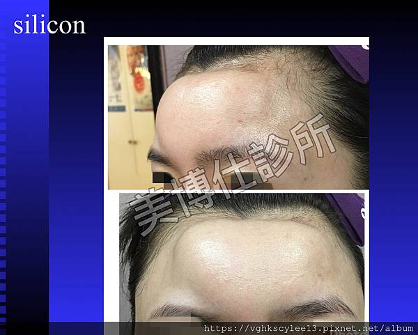 豐額後遺症：手術墊額頭假體出現邊界，為什麼？
