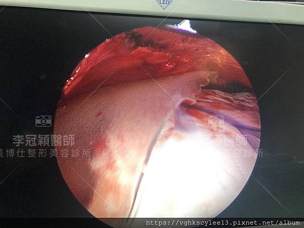 豐額後遺症：手術墊額頭假體出現邊界，為什麼？