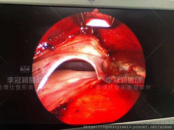 豐額後遺症：手術墊額頭假體出現邊界，為什麼？