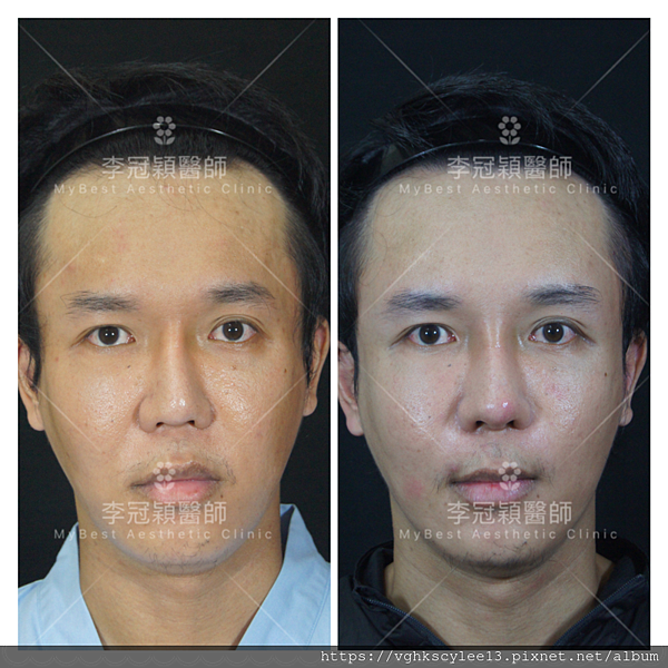 東方臉墊眉骨(隆眉骨)的輪廓效果,顏面T區打造的逆轉! 東方臉墊眉骨(隆眉骨)的輪廓效果,顏面T區打造的逆轉!