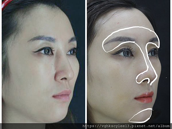 東方臉墊眉骨(隆眉骨)的輪廓效果,顏面T區打造的逆轉! 東方臉墊眉骨(隆眉骨)的輪廓效果,顏面T區打造的逆轉!