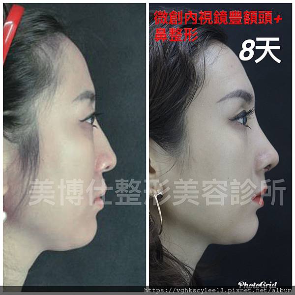 東方臉墊眉骨(隆眉骨)的輪廓效果,顏面T區打造的逆轉! 東方臉墊眉骨(隆眉骨)的輪廓效果,顏面T區打造的逆轉!