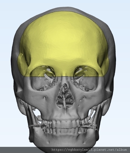 豐額後遺症：手術墊額頭假體出現邊界，為什麼？