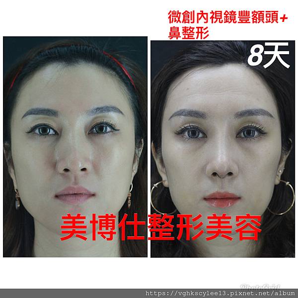 東方臉墊眉骨(隆眉骨)的輪廓效果,顏面T區打造的逆轉! 東方臉墊眉骨(隆眉骨)的輪廓效果,顏面T區打造的逆轉!