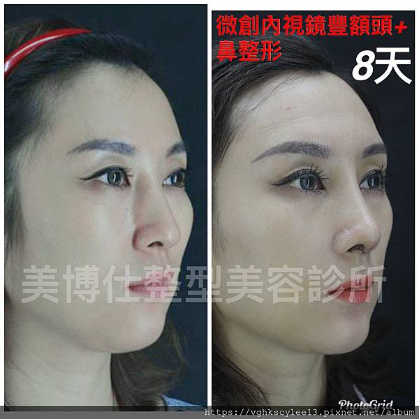 東方臉墊眉骨(隆眉骨)的輪廓效果,顏面T區打造的逆轉! 東方臉墊眉骨(隆眉骨)的輪廓效果,顏面T區打造的逆轉!