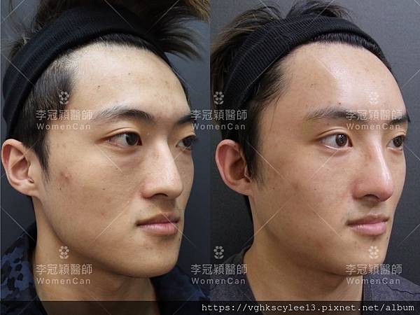 東方臉墊眉骨(隆眉骨)的輪廓效果,顏面T區打造的逆轉! 東方臉墊眉骨(隆眉骨)的輪廓效果,顏面T區打造的逆轉!