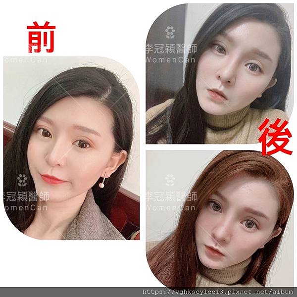 東方臉墊眉骨(隆眉骨)的輪廓效果,顏面T區打造的逆轉! 東方臉墊眉骨(隆眉骨)的輪廓效果,顏面T區打造的逆轉!