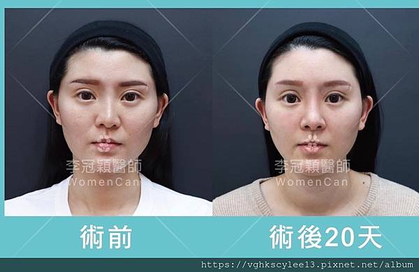 東方臉墊眉骨(隆眉骨)的輪廓效果,顏面T區打造的逆轉! 東方臉墊眉骨(隆眉骨)的輪廓效果,顏面T區打造的逆轉!