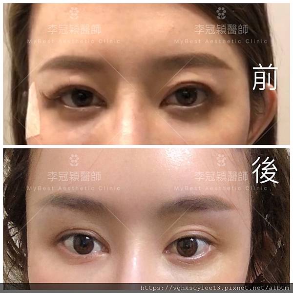 東方臉墊眉骨(隆眉骨)的輪廓效果,顏面T區打造的逆轉! 東方臉墊眉骨(隆眉骨)的輪廓效果,顏面T區打造的逆轉!