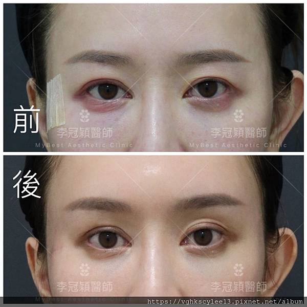 東方臉墊眉骨(隆眉骨)的輪廓效果,顏面T區打造的逆轉! 東方臉墊眉骨(隆眉骨)的輪廓效果,顏面T區打造的逆轉!