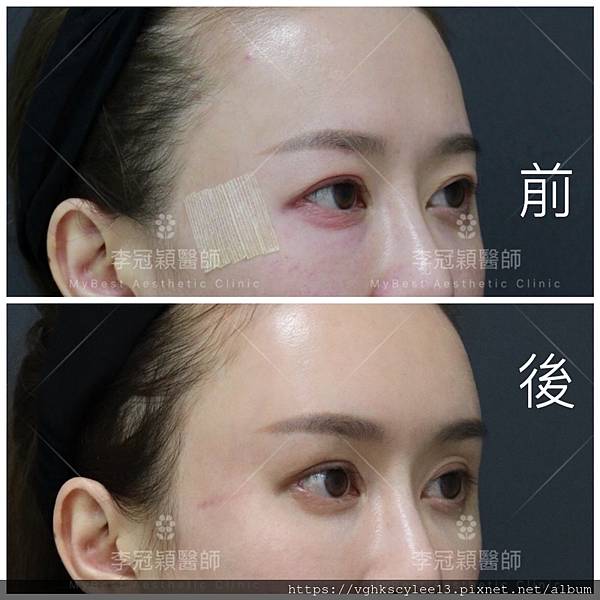 東方臉墊眉骨(隆眉骨)的輪廓效果,顏面T區打造的逆轉! 東方臉墊眉骨(隆眉骨)的輪廓效果,顏面T區打造的逆轉!