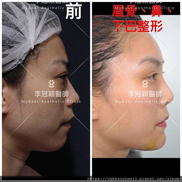 東方臉墊眉骨(隆眉骨)的輪廓效果,顏面T區打造的逆轉! 東方臉墊眉骨(隆眉骨)的輪廓效果,顏面T區打造的逆轉!