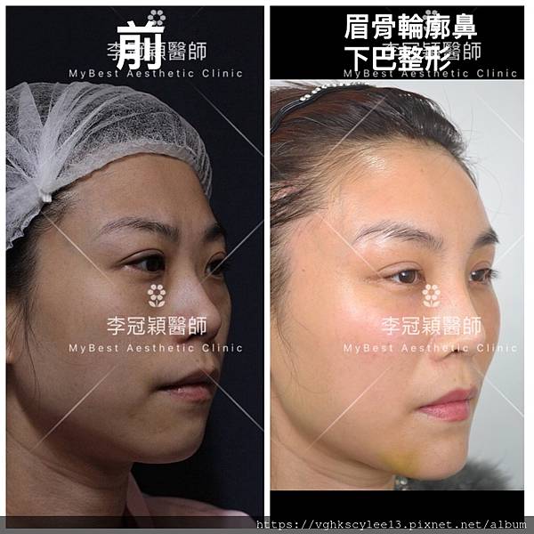 東方臉墊眉骨(隆眉骨)的輪廓效果,顏面T區打造的逆轉! 東方臉墊眉骨(隆眉骨)的輪廓效果,顏面T區打造的逆轉!