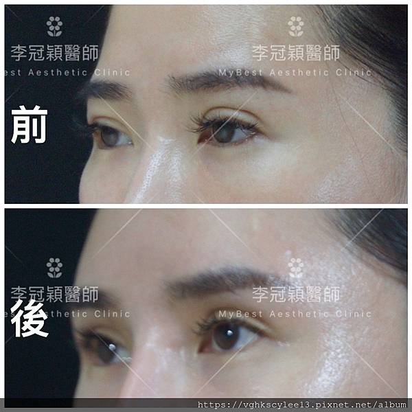 東方臉墊眉骨(隆眉骨)的輪廓效果,顏面T區打造的逆轉! 東方臉墊眉骨(隆眉骨)的輪廓效果,顏面T區打造的逆轉!