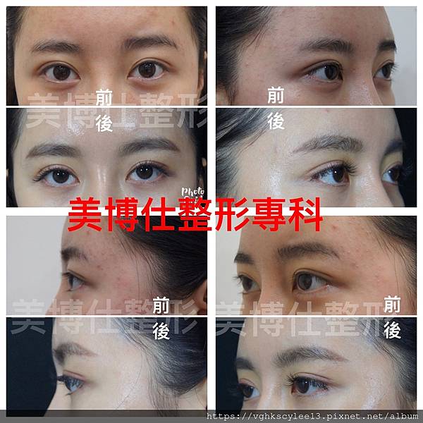 東方臉墊眉骨(隆眉骨)的輪廓效果,顏面T區打造的逆轉! 東方臉墊眉骨(隆眉骨)的輪廓效果,顏面T區打造的逆轉!