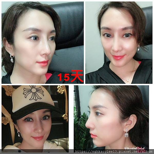 東方臉墊眉骨(隆眉骨)的輪廓效果,顏面T區打造的逆轉! 東方臉墊眉骨(隆眉骨)的輪廓效果,顏面T區打造的逆轉!