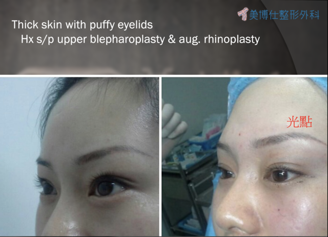 東方臉墊眉骨(隆眉骨)的輪廓效果,顏面T區打造的逆轉! 東方臉墊眉骨(隆眉骨)的輪廓效果,顏面T區打造的逆轉!