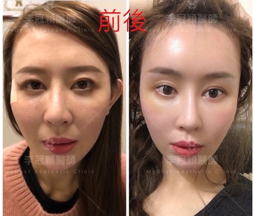 東方臉墊眉骨(隆眉骨)的輪廓效果,顏面T區打造的逆轉! IMG_3753.JPG - 墊額頭