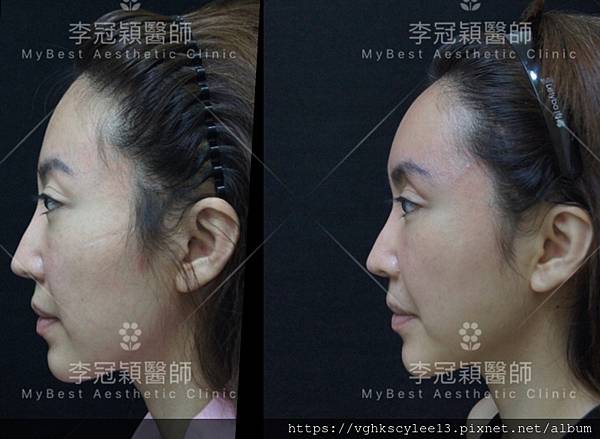 東方臉墊眉骨(隆眉骨)的輪廓效果,顏面T區打造的逆轉! 東方臉墊眉骨(隆眉骨)的輪廓效果,顏面T區打造的逆轉!