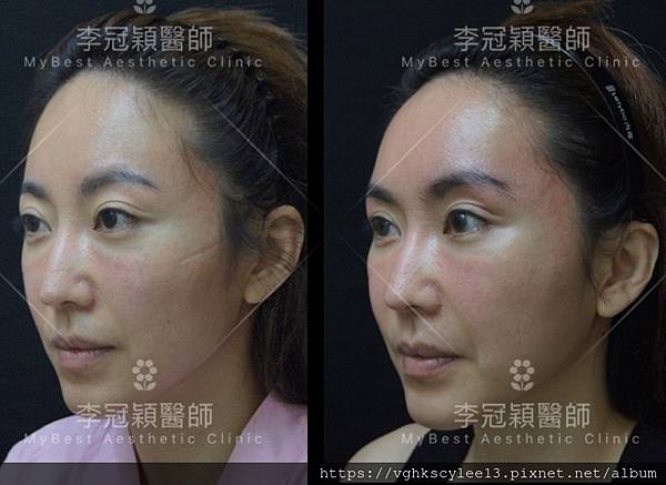 東方臉墊眉骨(隆眉骨)的輪廓效果,顏面T區打造的逆轉! 東方臉墊眉骨(隆眉骨)的輪廓效果,顏面T區打造的逆轉!