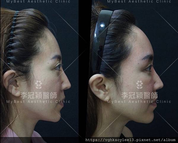 東方臉墊眉骨(隆眉骨)的輪廓效果,顏面T區打造的逆轉! 東方臉墊眉骨(隆眉骨)的輪廓效果,顏面T區打造的逆轉!