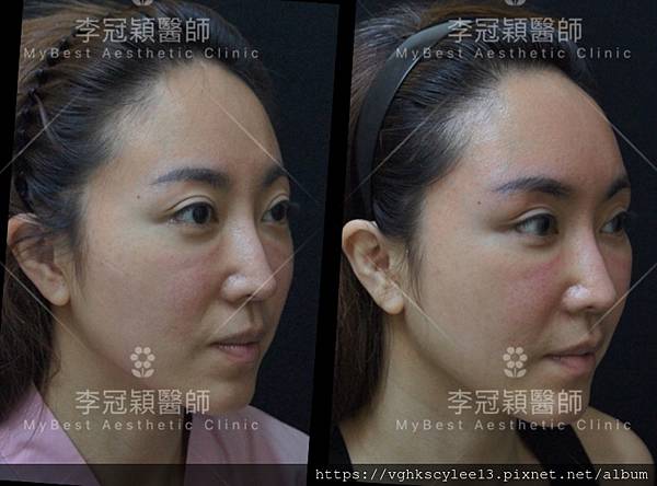 東方臉墊眉骨(隆眉骨)的輪廓效果,顏面T區打造的逆轉! 東方臉墊眉骨(隆眉骨)的輪廓效果,顏面T區打造的逆轉!