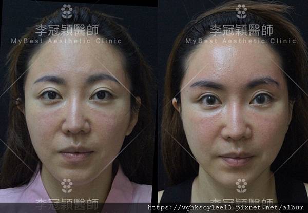 東方臉墊眉骨(隆眉骨)的輪廓效果,顏面T區打造的逆轉! 東方臉墊眉骨(隆眉骨)的輪廓效果,顏面T區打造的逆轉!