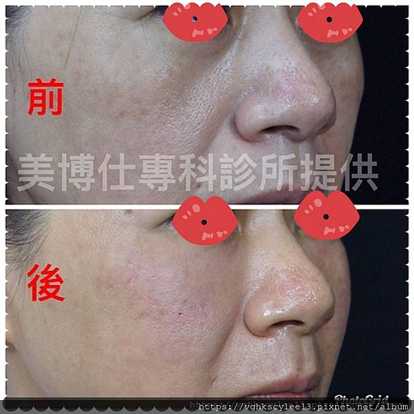 注射填充蘋果肌與墊片蘋果肌，哪個造成後續下垂？