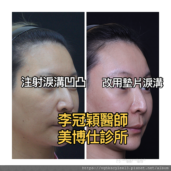 注射填充蘋果肌與墊片蘋果肌，哪個造成後續下垂？