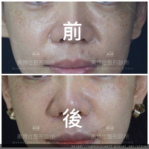 注射填充蘋果肌與墊片蘋果肌，哪個造成後續下垂？