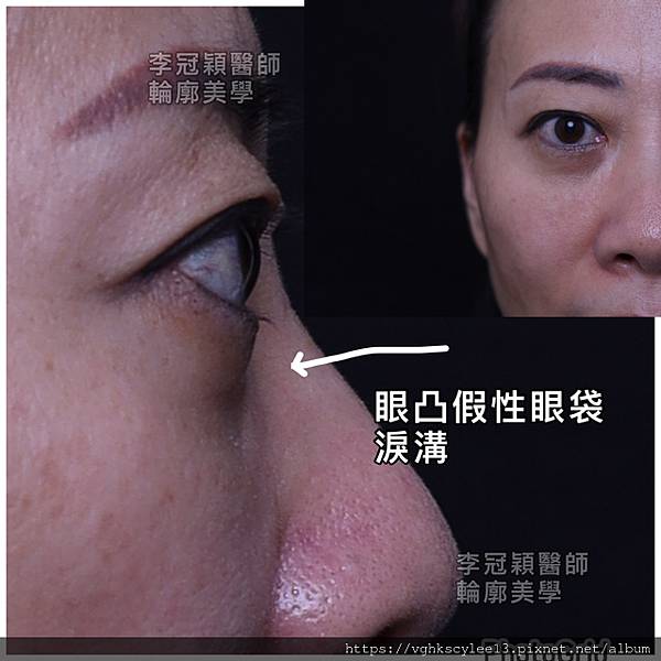 骨架外型和組織肉的厚度應該多少比例？3D列印技術墊蘋果肌給妳