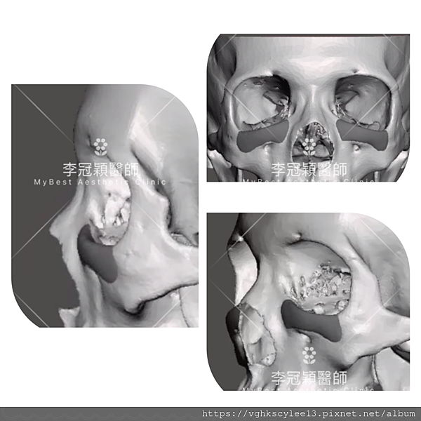 注射填充蘋果肌與墊片蘋果肌，哪個造成後續下垂？