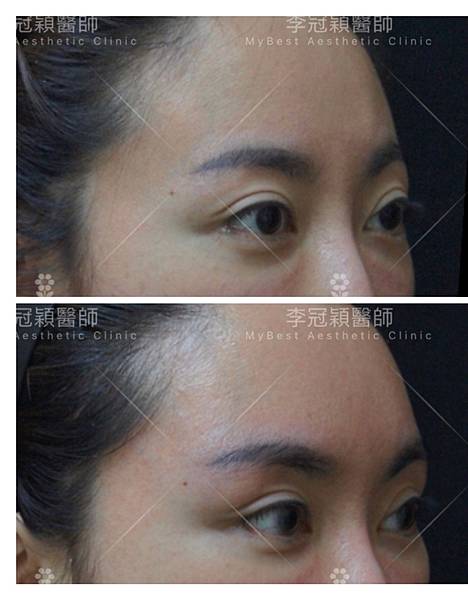 東方臉墊眉骨(隆眉骨)的輪廓效果,顏面T區打造的逆轉! 東方臉墊眉骨(隆眉骨)的輪廓效果,顏面T區打造的逆轉!