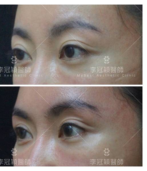 東方臉墊眉骨(隆眉骨)的輪廓效果,顏面T區打造的逆轉! 東方臉墊眉骨(隆眉骨)的輪廓效果,顏面T區打造的逆轉!