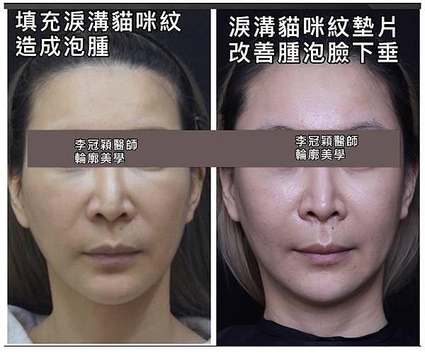 注射填充蘋果肌與墊片蘋果肌，哪個造成後續下垂？