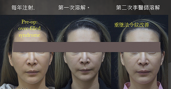 注射填充蘋果肌與墊片蘋果肌，哪個造成後續下垂？