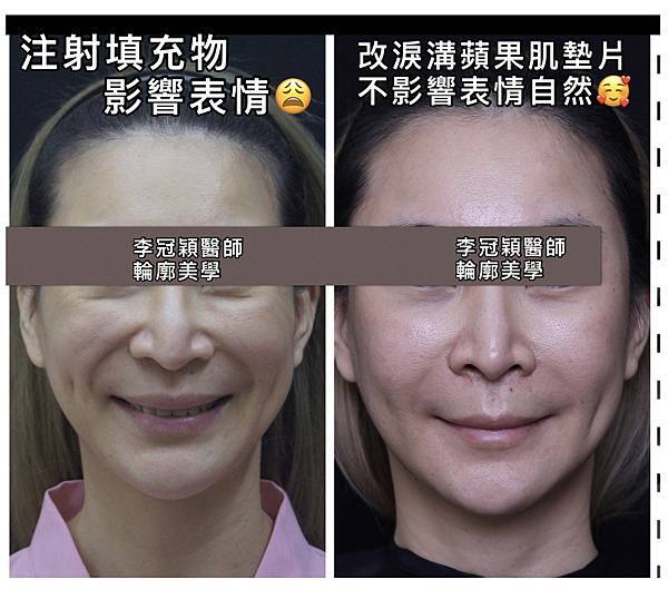 注射填充蘋果肌與墊片蘋果肌，哪個造成後續下垂？