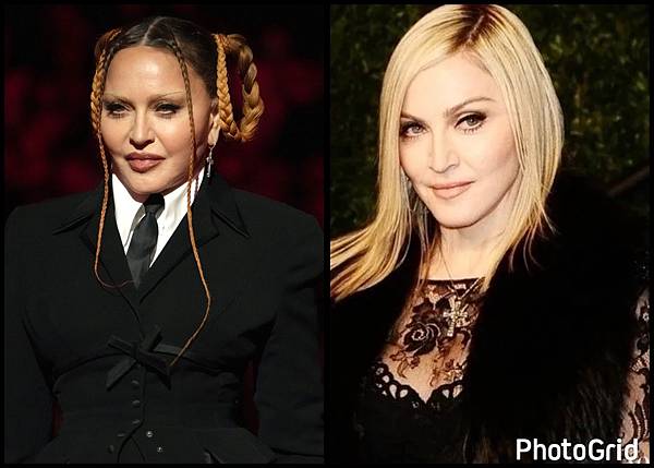 注射填充蘋果肌與墊片蘋果肌，哪個造成後續下垂？