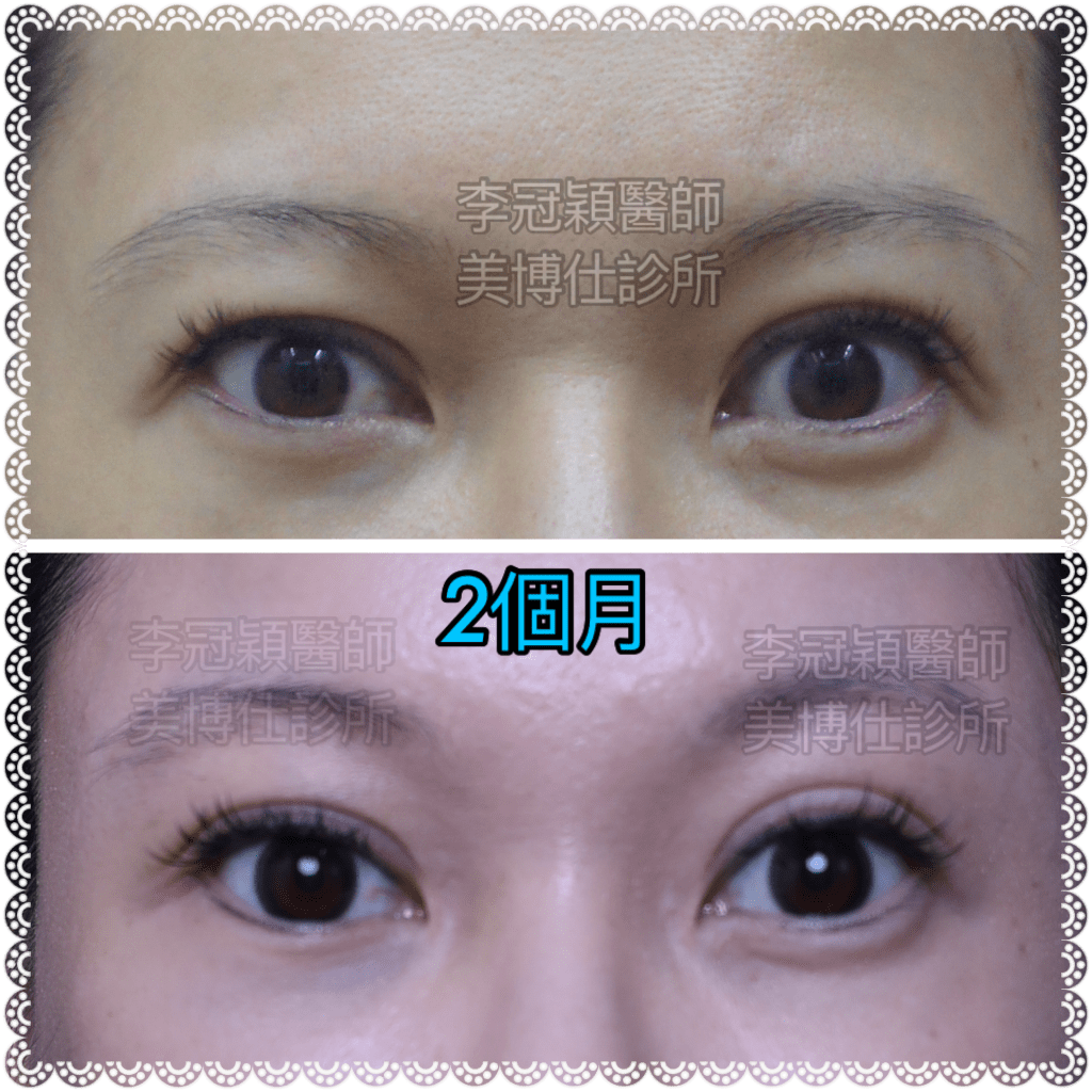 真實回到年輕的眼睛— 微創提眉術