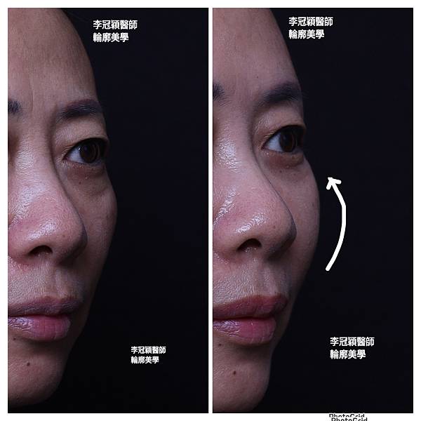 骨架外型和組織肉的厚度應該多少比例？3D列印技術墊蘋果肌給妳