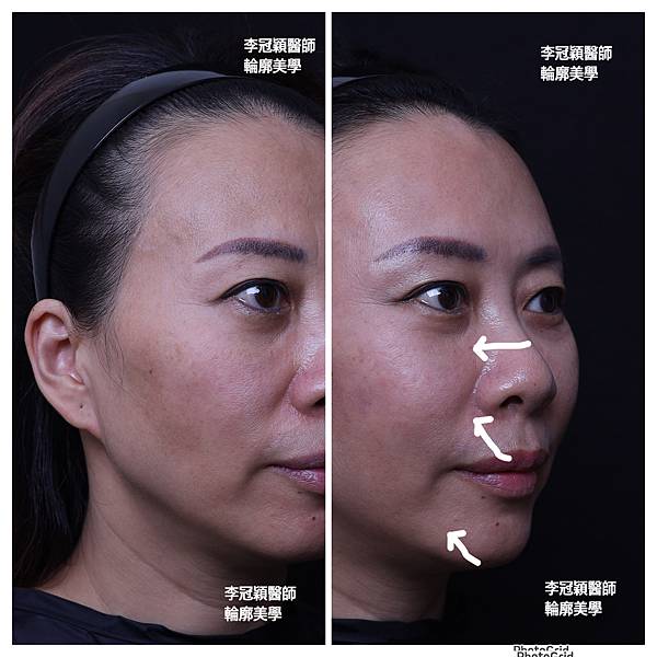 骨架外型和組織肉的厚度應該多少比例？3D列印技術墊蘋果肌給妳