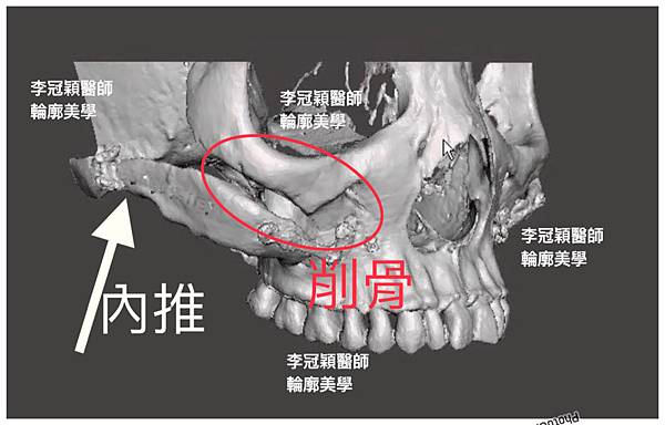 骨架外型和組織肉的厚度應該多少比例？3D列印技術墊蘋果肌給妳