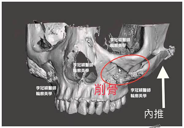 骨架外型和組織肉的厚度應該多少比例？3D列印技術墊蘋果肌給妳